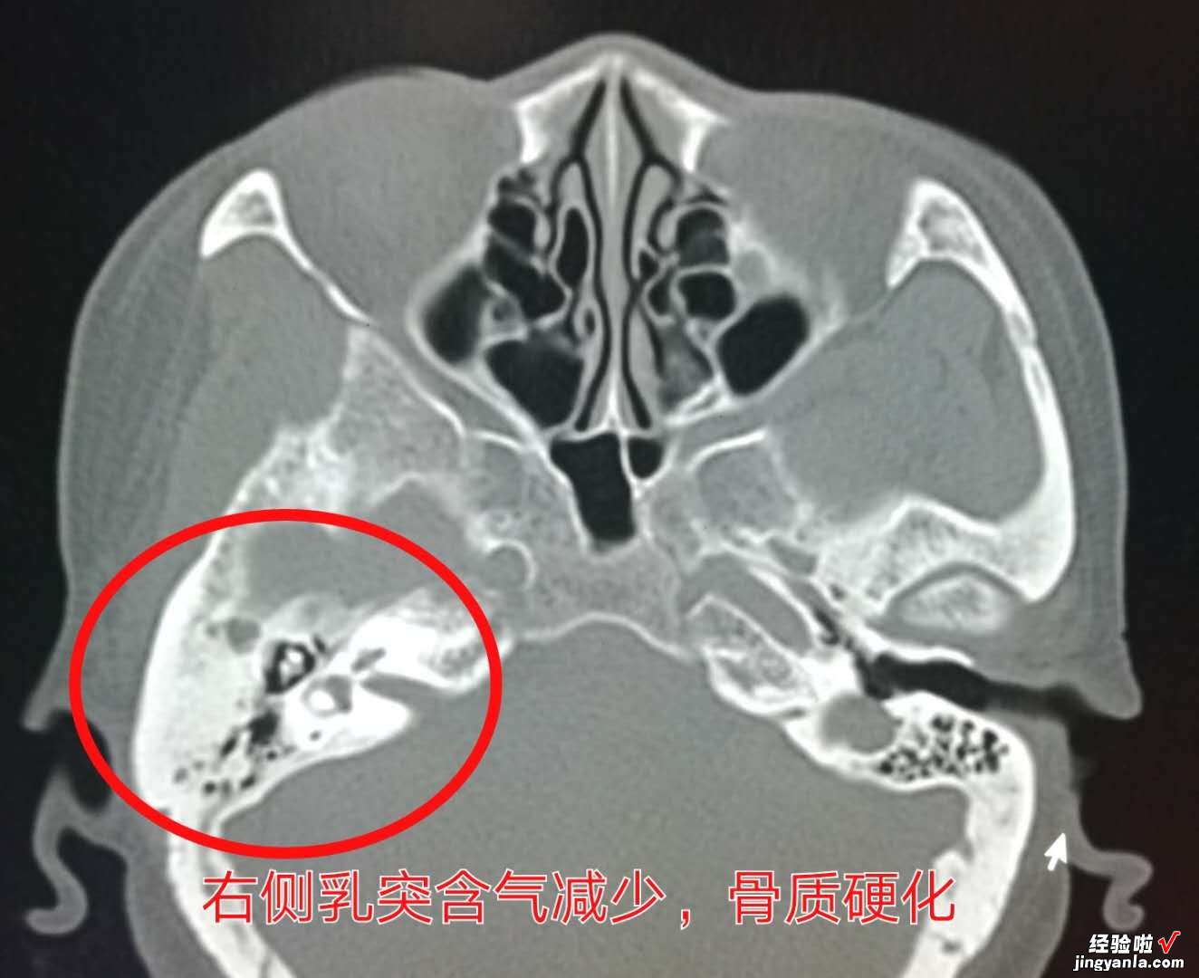 孩子的听力无故下降？中耳炎时怎么得的？如何有效预防？