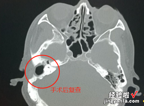 孩子的听力无故下降？中耳炎时怎么得的？如何有效预防？