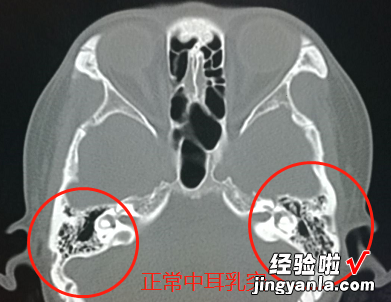 孩子的听力无故下降？中耳炎时怎么得的？如何有效预防？