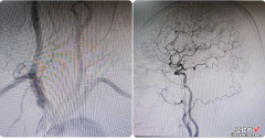 改变造影通道的新技术——经手臂桡动脉入路全脑血管造影术