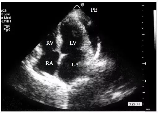 医霸解读！心包积液的二维超声心动图表现