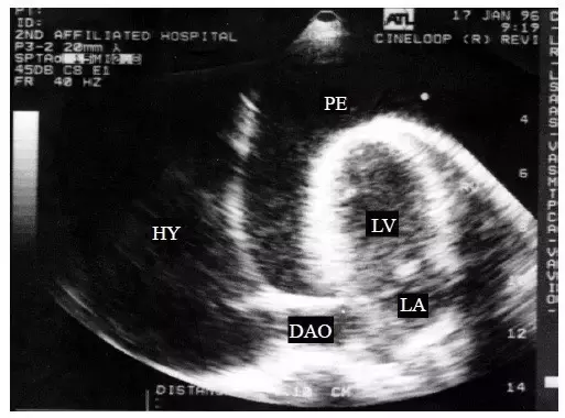 医霸解读！心包积液的二维超声心动图表现