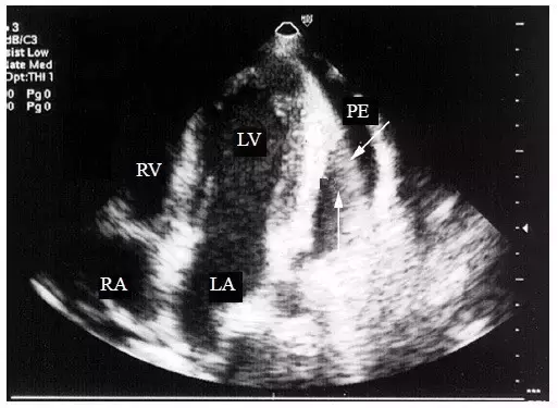 医霸解读！心包积液的二维超声心动图表现