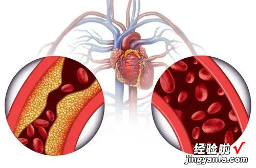 我们该如何预防血管堵塞-如何预防血栓堵塞